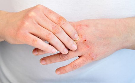 乳膠手套能否有效防止長水泡？